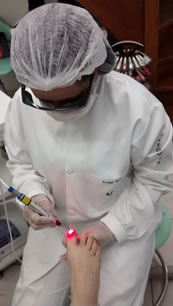 Podologia Clínica - Tratamento da Onicomicose com Laser